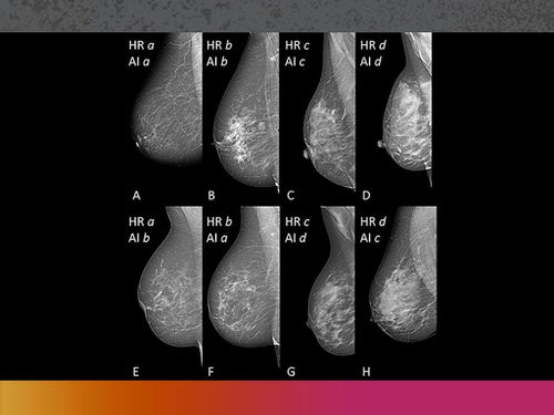 Tópicos Selectos en Imagenología de la Mama 